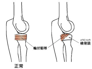 肘内障の説明